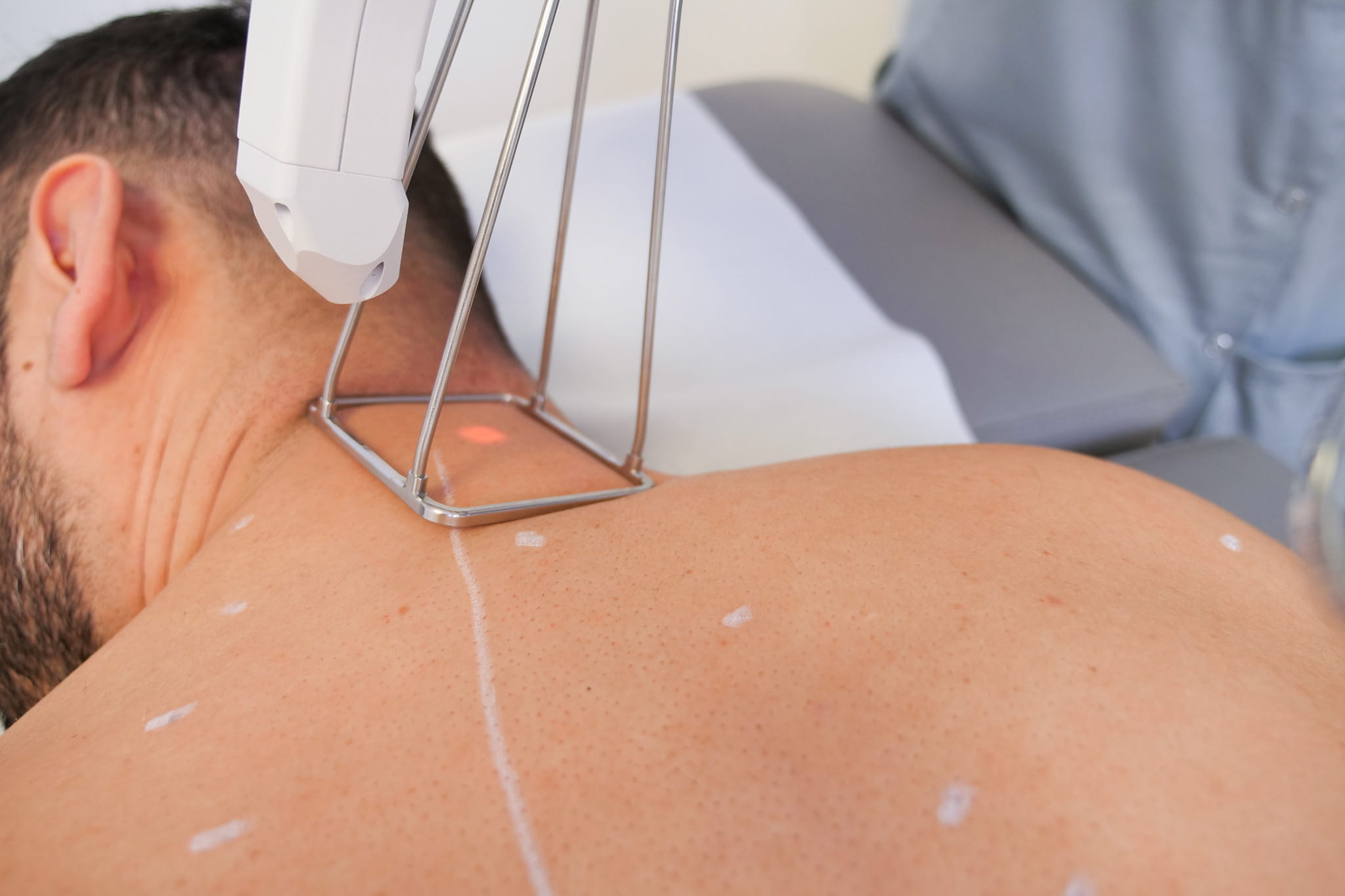 Nacken Haare Lasern lassen bei Männern 